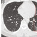 CT Imaging Features of Patients Infected with COVID 2019