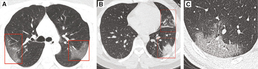 CT Imaging Features of Patients Infected with COVID 2019