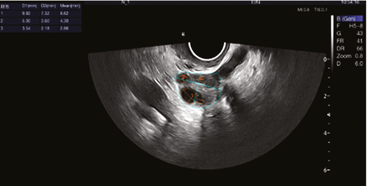 Deep Learning Based Two Dimensional Ultrasound For Follicle Monitoring