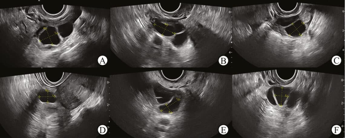 Deep-Learning-Based-TwoDimensional-Ultrasound-for-Follicle-Monitoring-in-Infertility-Patient
