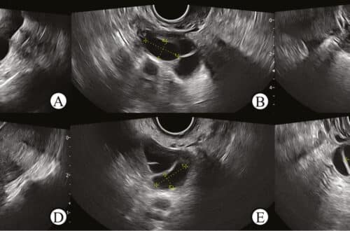 Deep-Learning-Based-TwoDimensional-Ultrasound-for-Follicle-Monitoring-in-Infertility-Patient
