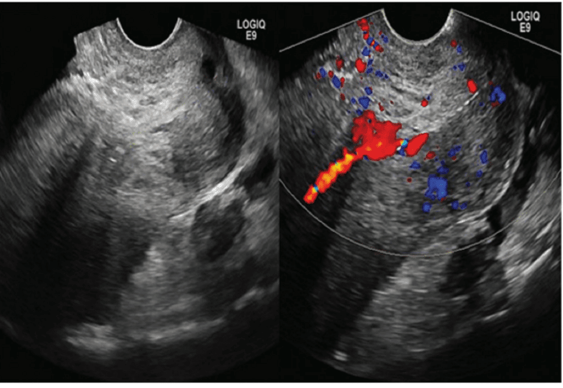 Preliminary Investigation into Ultrasound and MRI Presentation of Large-Cell Neuroendocrine Carcinomas of the Uterine Cervix